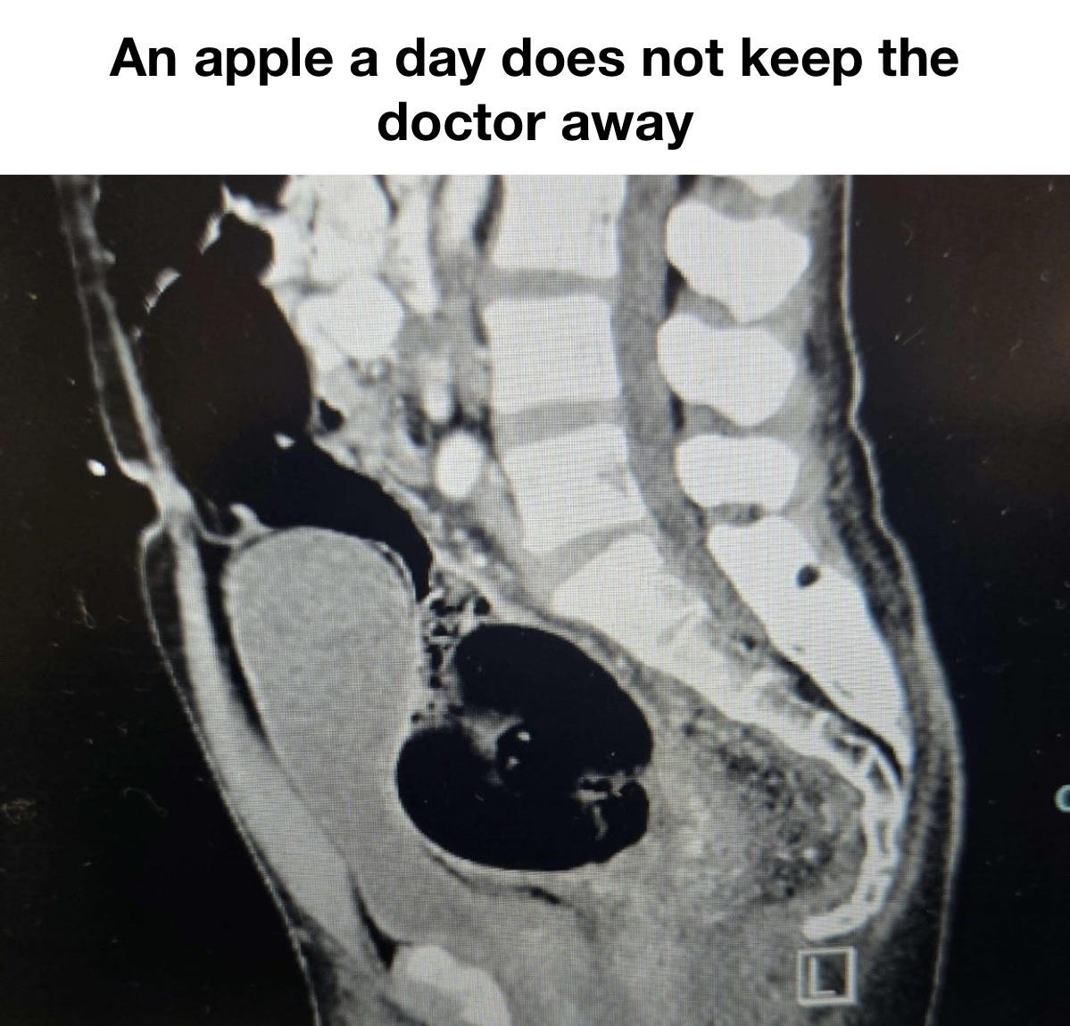 CT Scan Meme: An Apple A Day Surprise